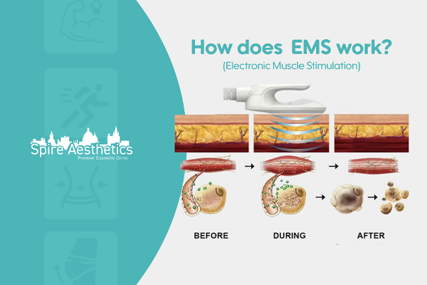 EMS treatment for post pregnancy weight loss treatment Luton