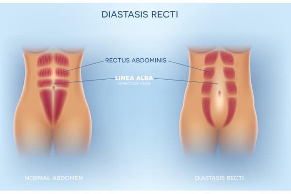 What Non-Surgical Options Are Available for Diastasis Recti Luton?