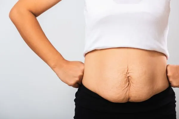 Image of a woman's stomach after weight loss with sagging skin following a gastric band Luton