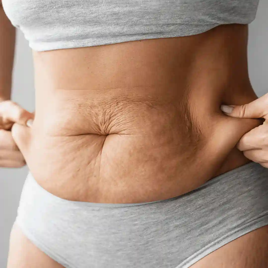 Is It Normal to Have Loose Skin After Pregnancy Luton?