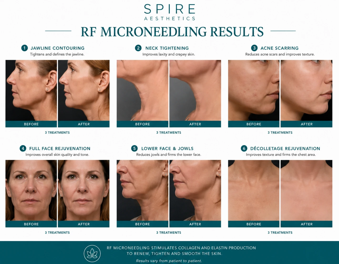 RF Microneedling Skin tightening Luton results