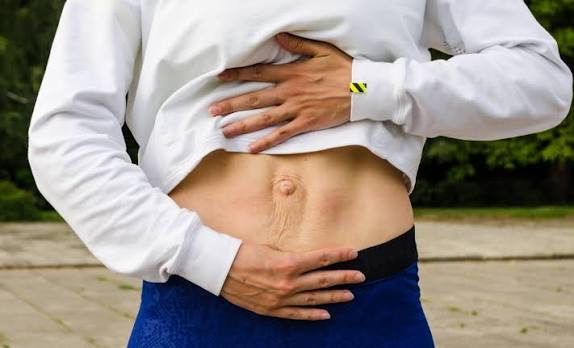 When Could Diastasis Recti Be the Missing Piece of the Puzzle Luton?